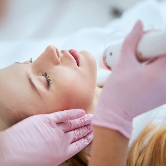 RF Microneedling