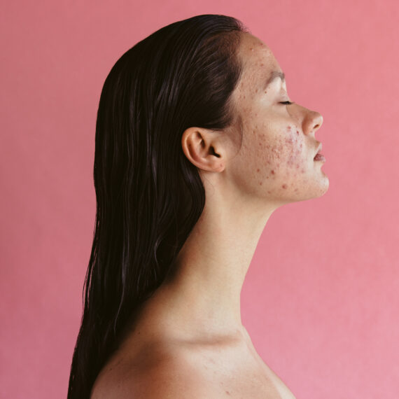 Side view portrait of woman with acne inflammation on pink background. Skin disorders lead to depression and insecurities in women.